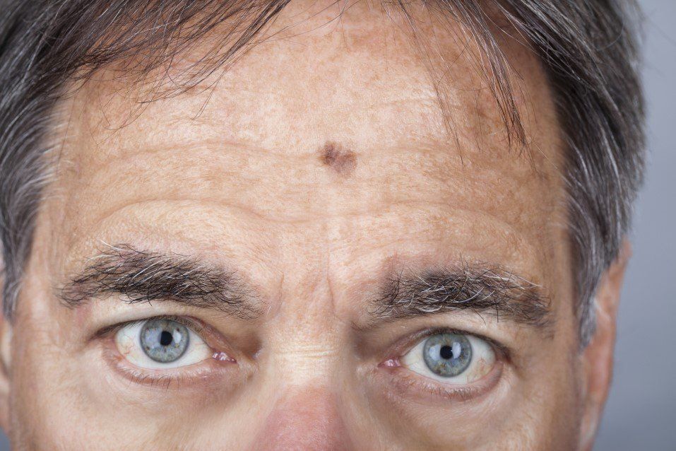 Close-up of a man’s eyes and forehead with a dark mole on the center of his forehead.