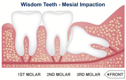 Mesial Impaction