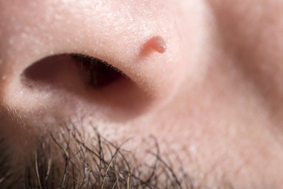 Close-up of a nose with a small reddish bump near the nostril.