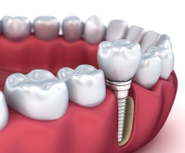 Illustration of dental implants supporting a white crown in pink gums beside natural teeth