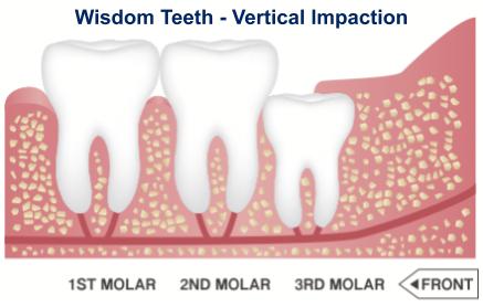 Vertical Impaction