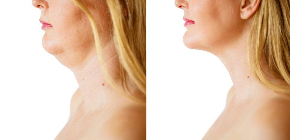 Side-by-side profile of a neck before and after cosmetic tightening against a white background
