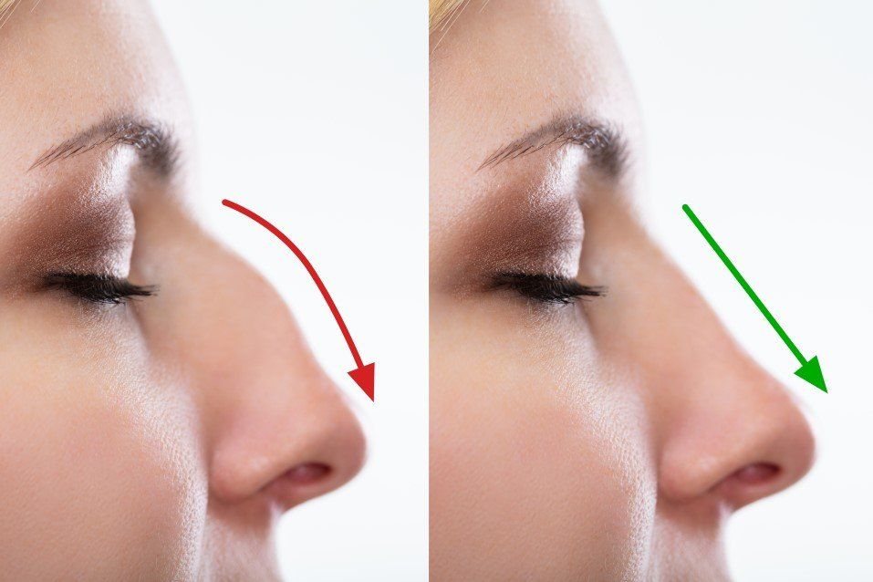 Side-by-side profile photos showing a nose before and after, with red and green arrows indicating change.