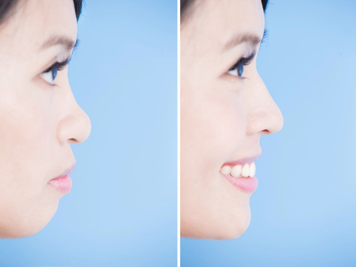Side-by-side profile close-ups of a woman, before and after smiling, against a light blue background