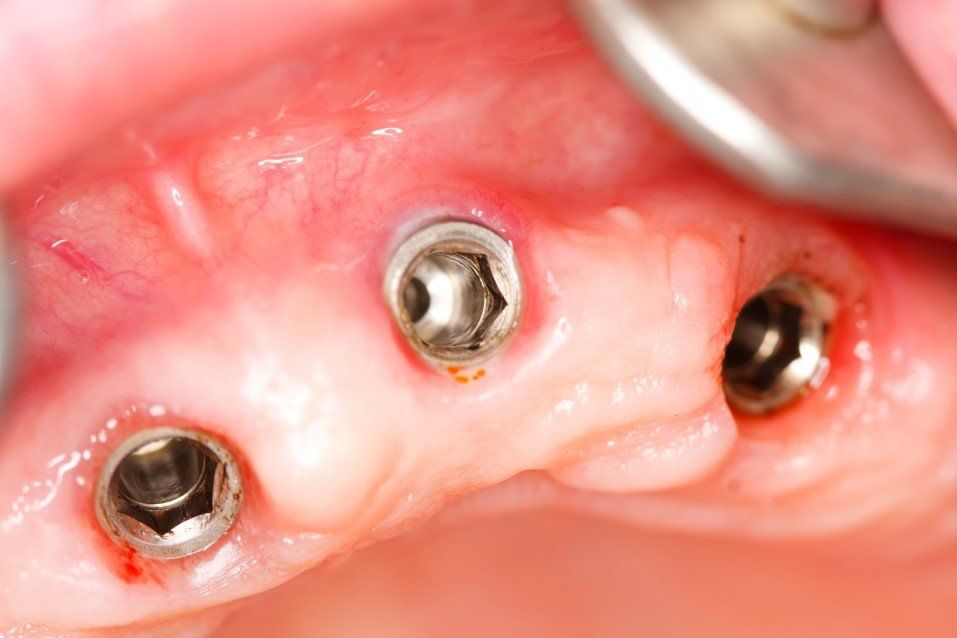 Close-up of pink gums with three metal dental implants or abutments protruding
