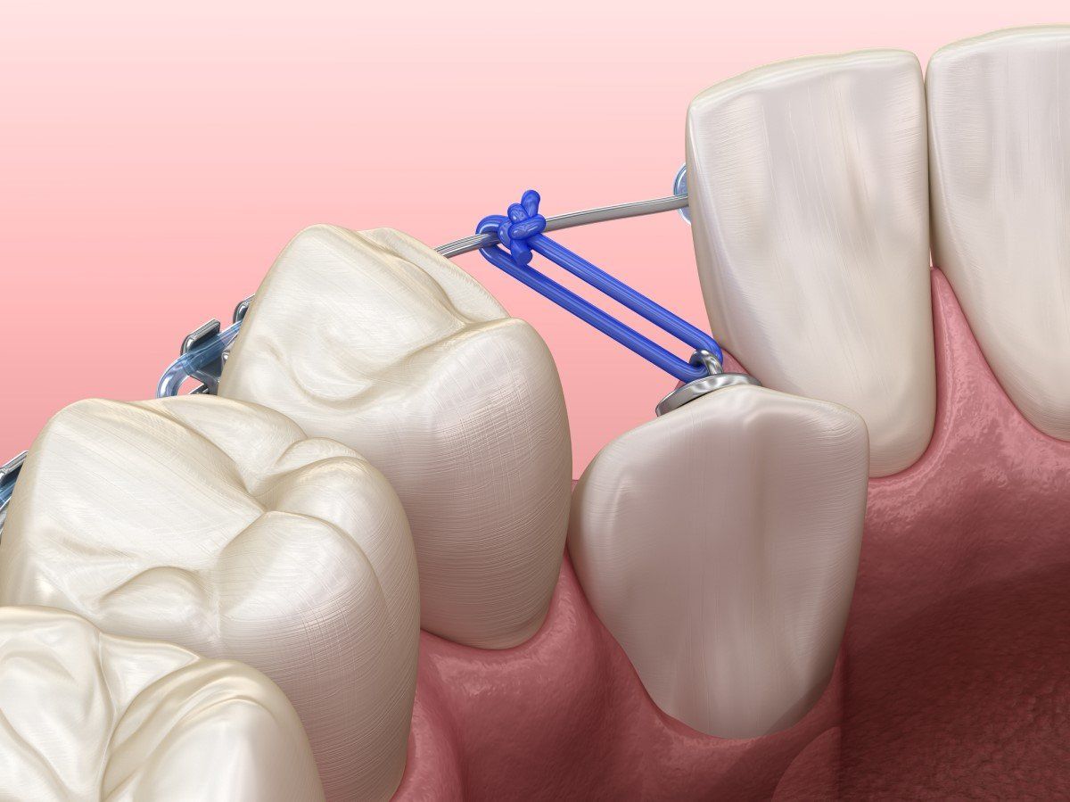impacted teeth