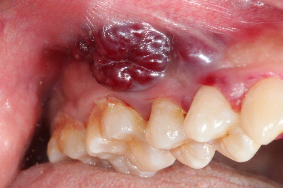 Close-up of a mouth with a dark red swollen growth on the upper gum near the teeth