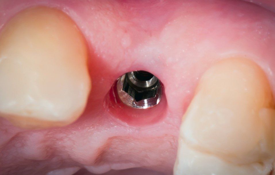 Close-up of a dental implant abutment between two teeth with pink gum tissue