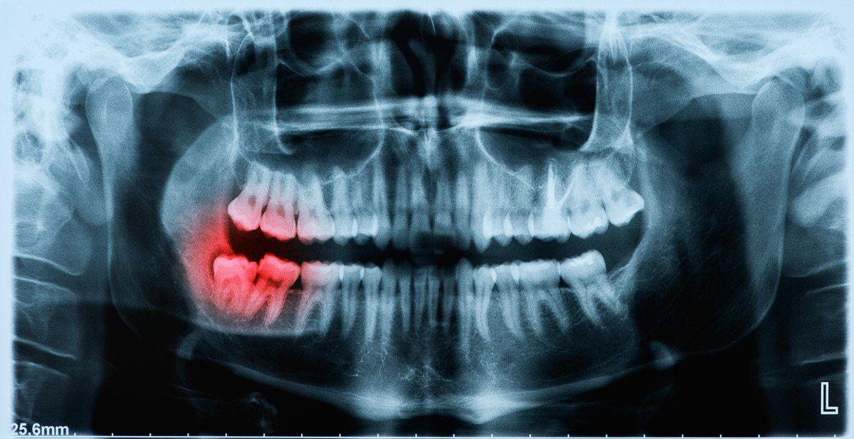 ectopic teeth