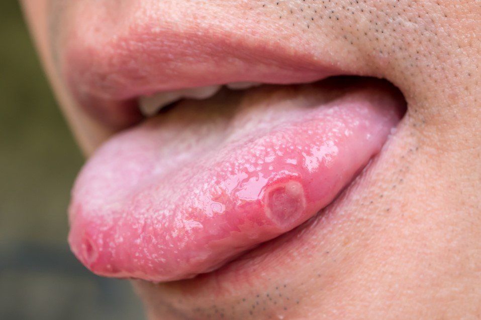 Close-up of a tongue with a red, swollen bump near the tip