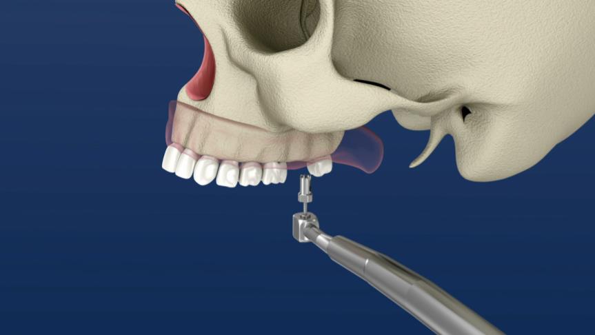 3D dental illustration of upper teeth and jaw with a drill tool near the front teeth