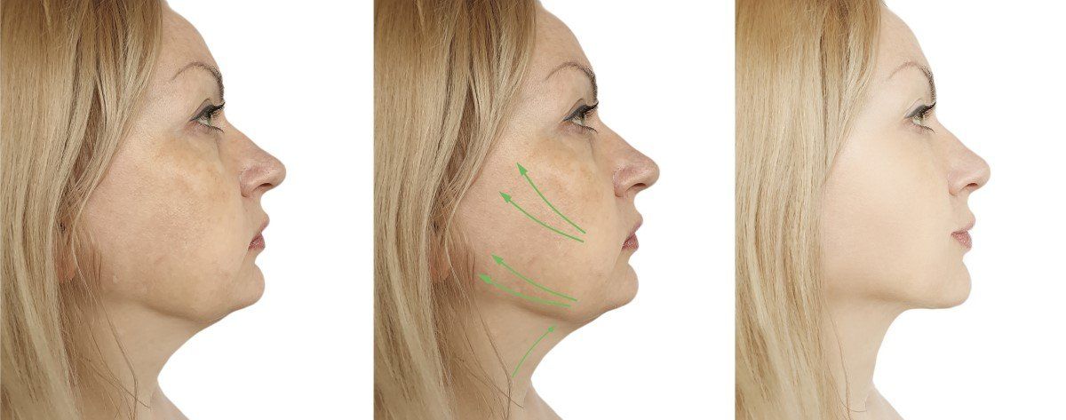Side-profile comparison of a woman’s jawline before, during, and after facial contour markings