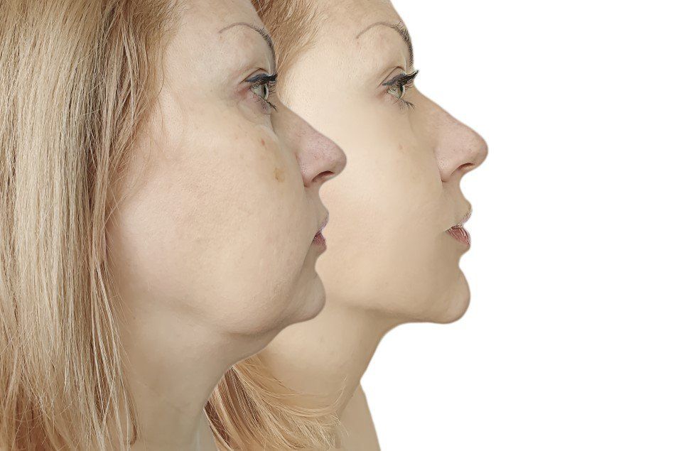 Side-profile comparison of two faces, one with a protruding nose and jaw, on a white background