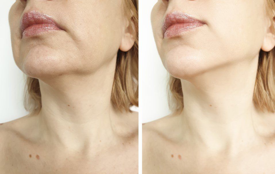 Side-by-side close-up of a person’s lower face and neck, showing before-and-after skin appearance.