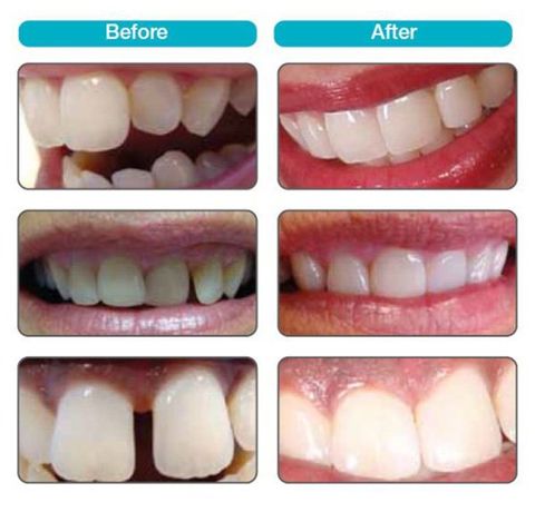 ProVeneer before and after images