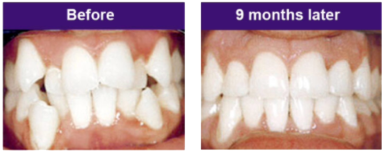 FastBraces Results FastBraces Results
