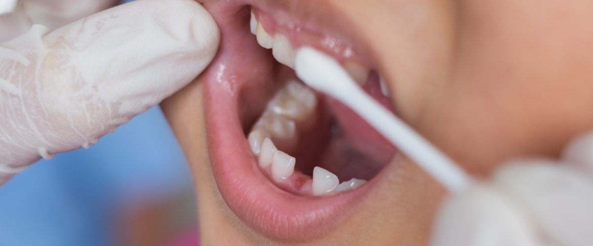Dental Fluoride Dental Fluoride