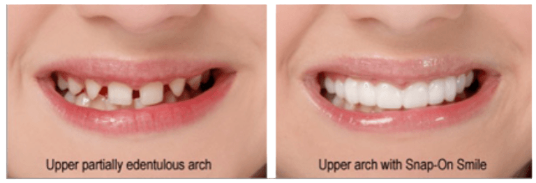 Snap-On Smile Snap-On Smile