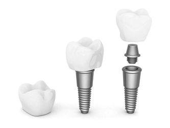 Dental Implant — Dental work in Clinton, MS Dental Implant — Dental work in Clinton, MS