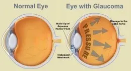 schema del glaucoma