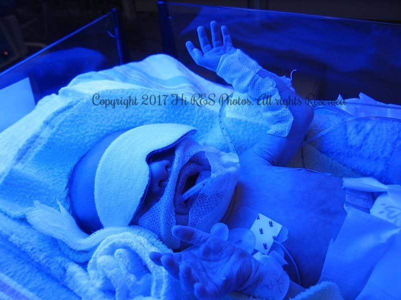 A baby is laying in a hospital bed under a blue light ..