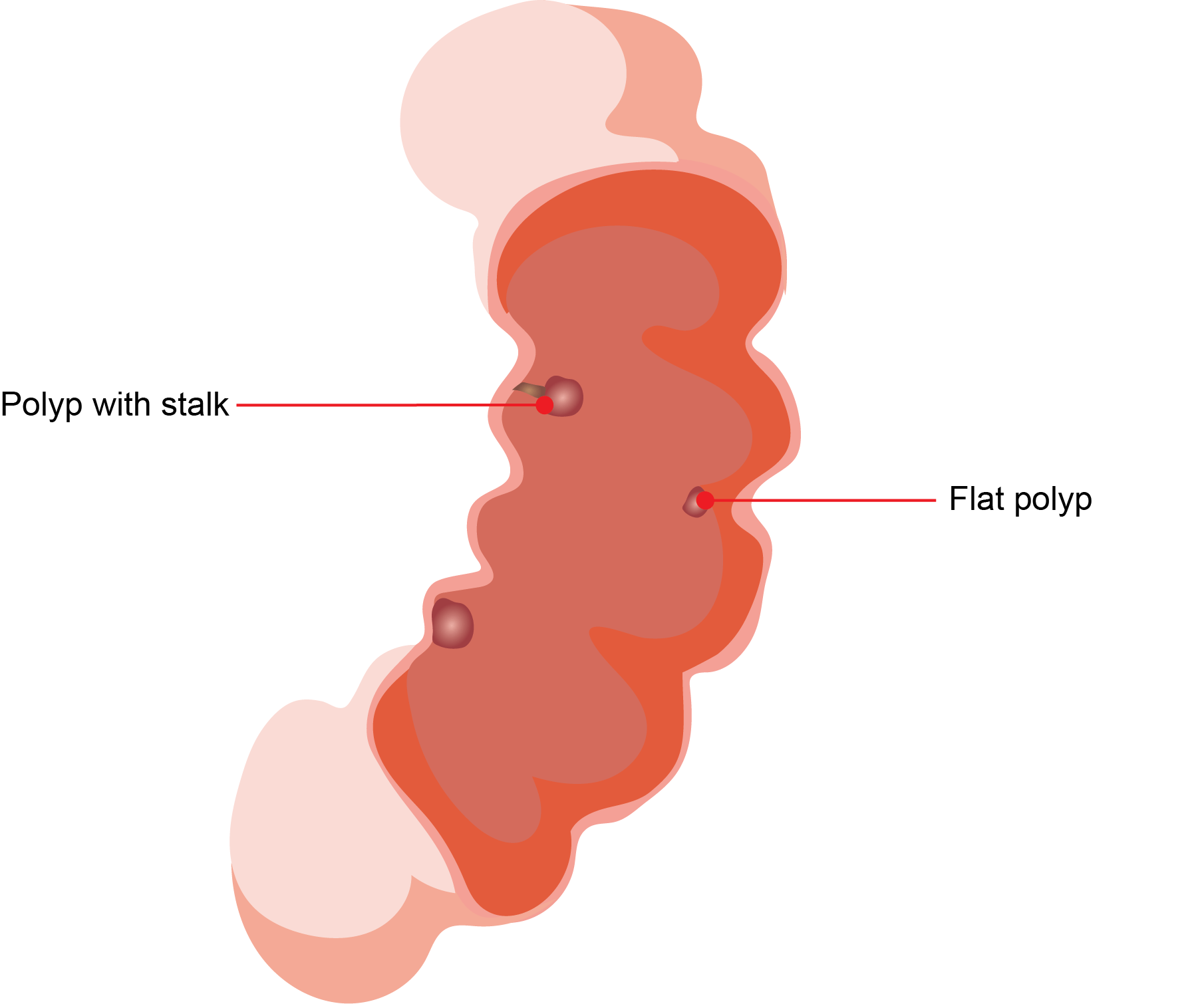 Colonic Polyps