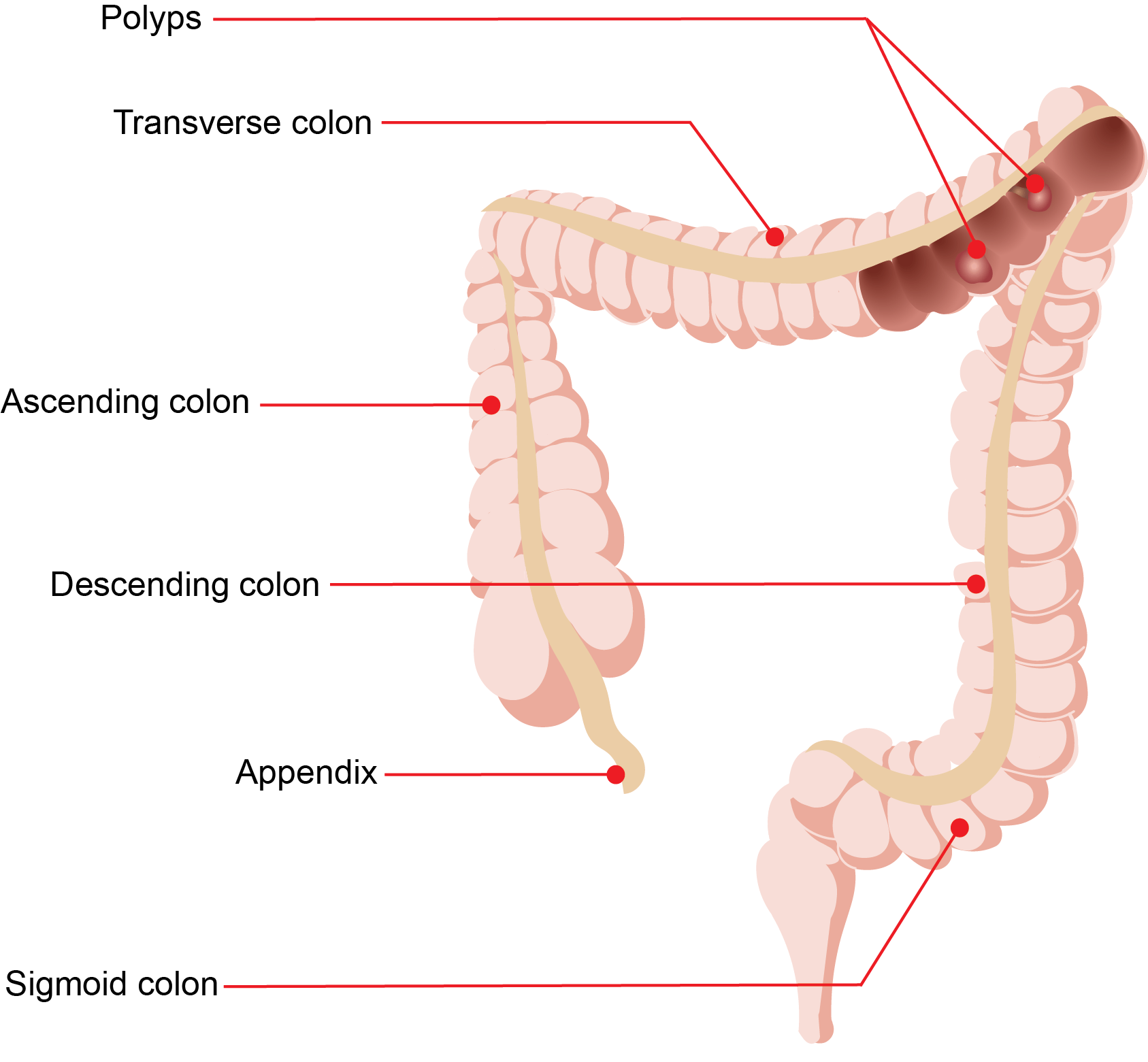 Colonic Polyps