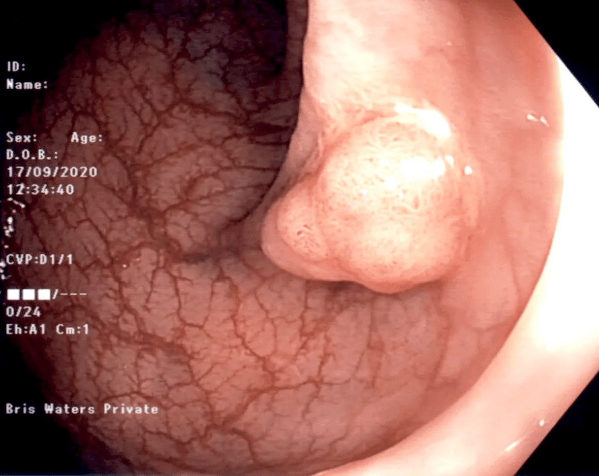 Colonic Polyp