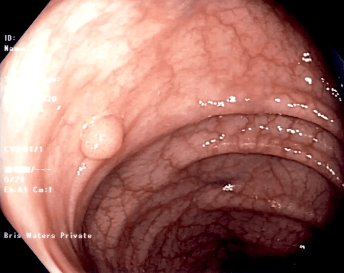 Colonic Polyp