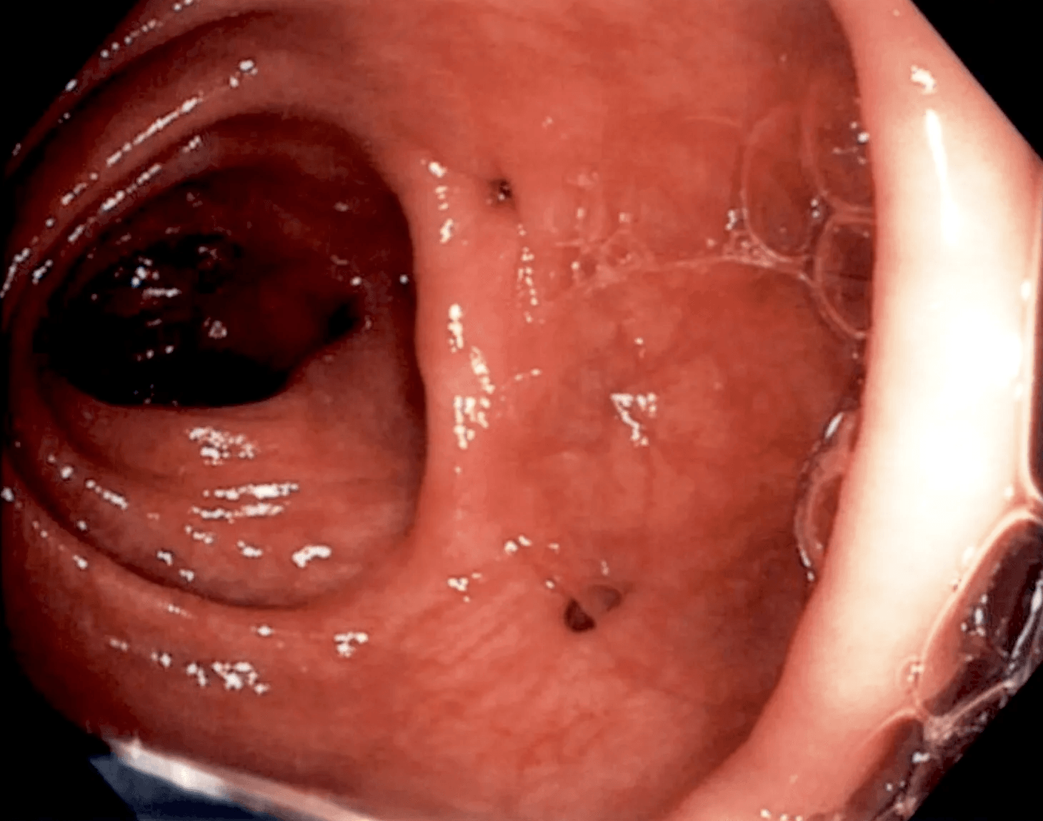 Diverticular Disease