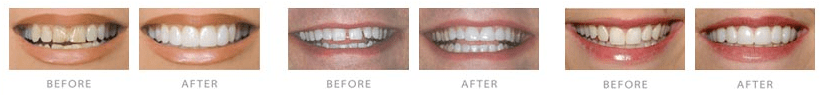 Lumineers Before&After — Dental Care in Orland, Park Lumineers Before&After — Dental Care in Orland, Park