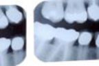 Fillings — Dentals Services in Orland Park, Illinois Fillings — Dentals Services in Orland Park, Illinois