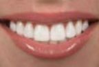 Veneers — Dentals Services in Orland Park, Illinois Veneers — Dentals Services in Orland Park, Illinois