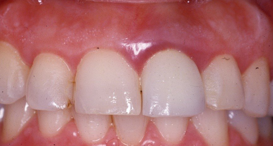 denti