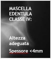 mascella edentula