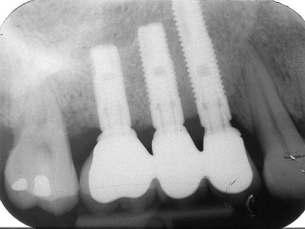 Tre impianti inseriti in un adeguato volume di osso residuo