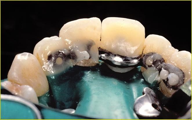 denti