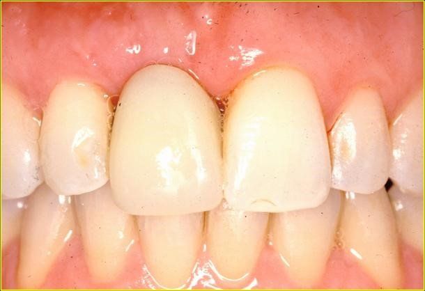 denti