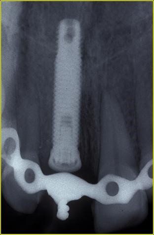 denti