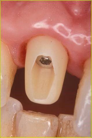denti