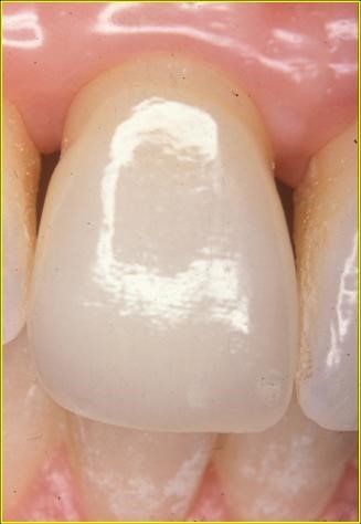 denti