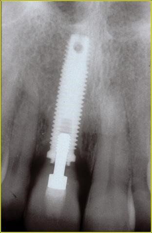 denti