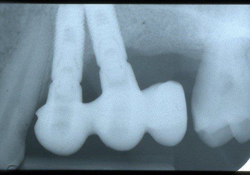 denti