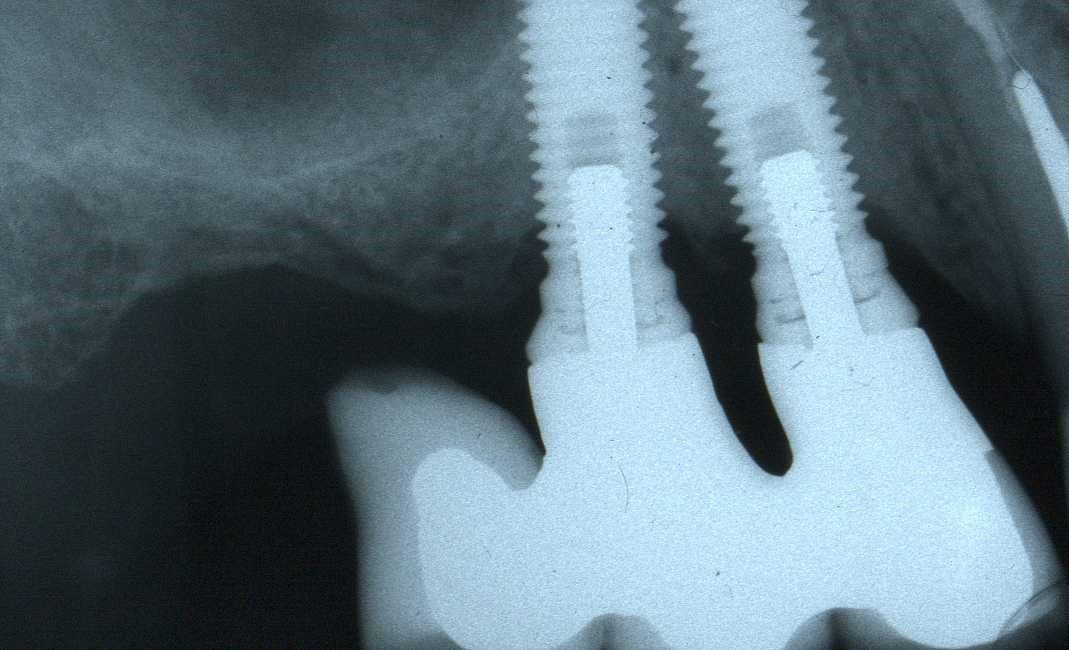 denti