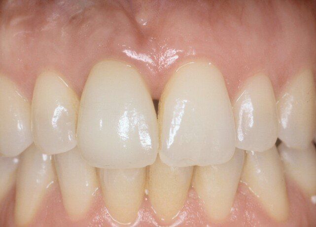 denti