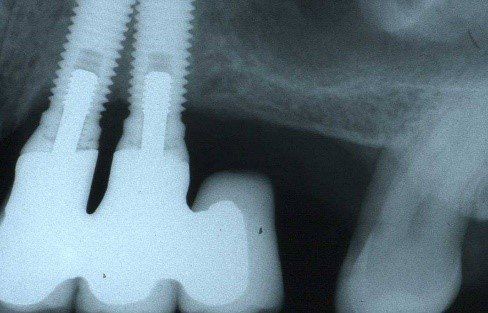 denti