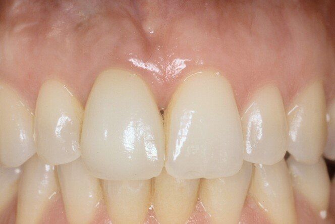 denti