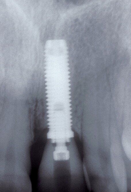 denti