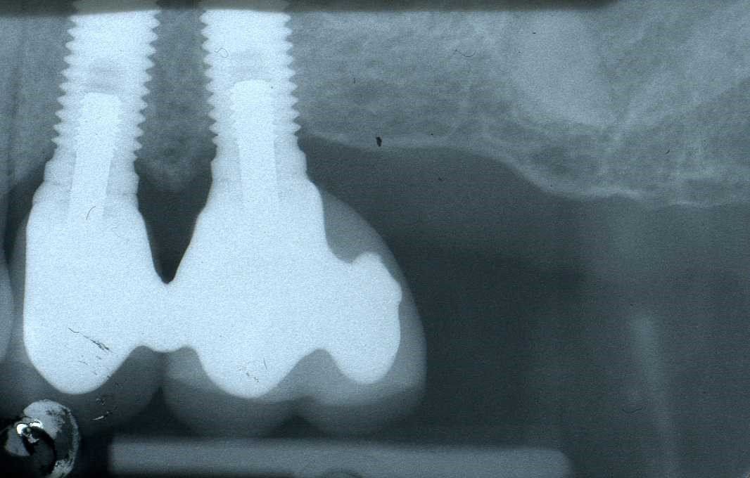 denti