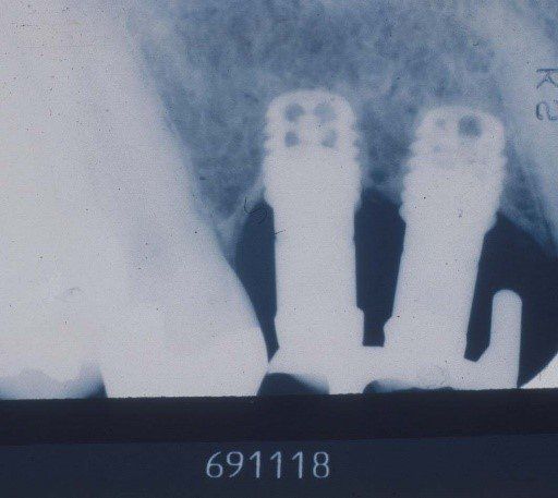 denti perni